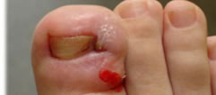 Ingrown nail